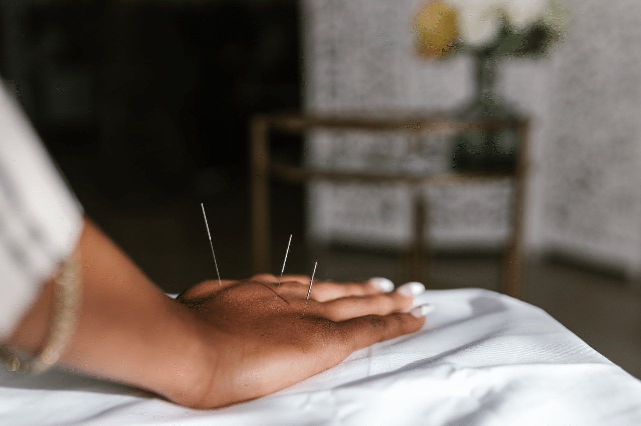A manicured hand sits on a table with 3 acupuncture needles in between the knuckles.