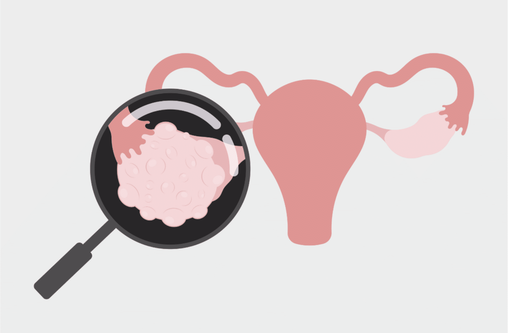 How can Different Cysts Can Affect Your Egg Freezing Cycle